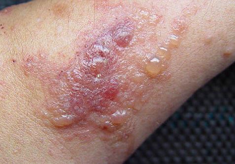 Home-remedies-for-poison-ivy-rash