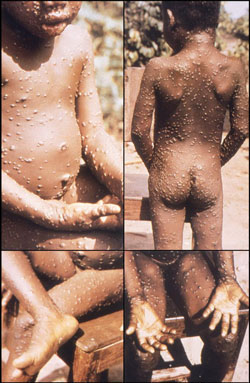 CDC证实亚城一旅客感染了猴痘，死亡率高达10%，无疫苗！
