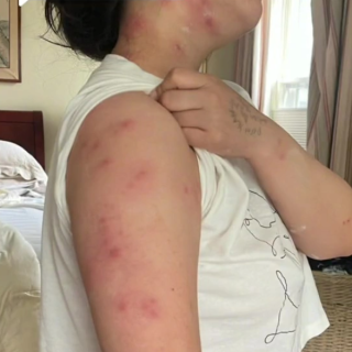 「好癢！」女子在旅館被咬一身包 從脖子到手臂無一倖免 都是床惹的禍！